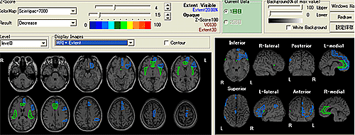 脳血流SPECTのvbSEE解析によるうつ病群の脳血流変化の客観化